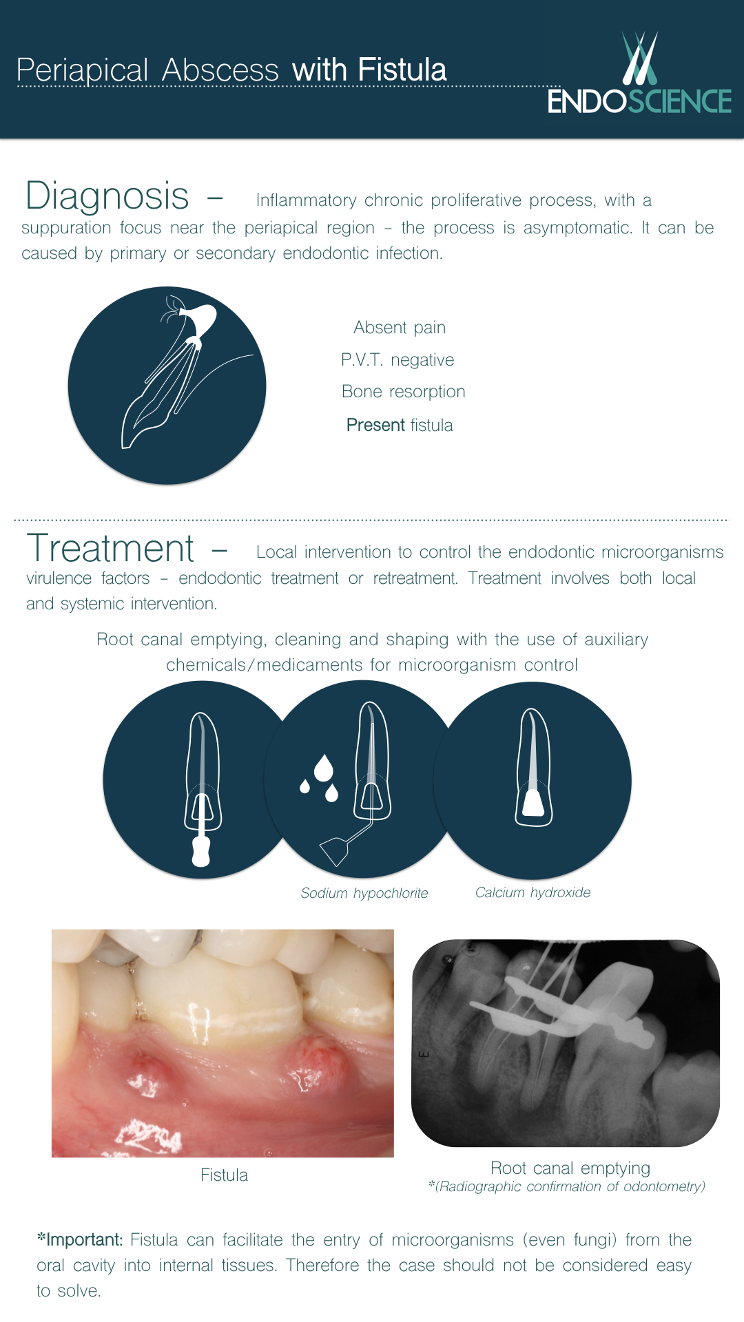 Periapical Abscess with Fistula | Endoscience